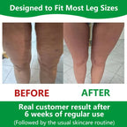 Cellulite Massage Roller | 360° Deep-Tissue Rollers & Adjustable Fit