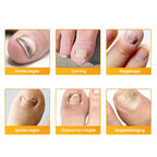 Nail Fungus Patch | Deep-Acting Antifungal & Medical Fleece | Pack of 2