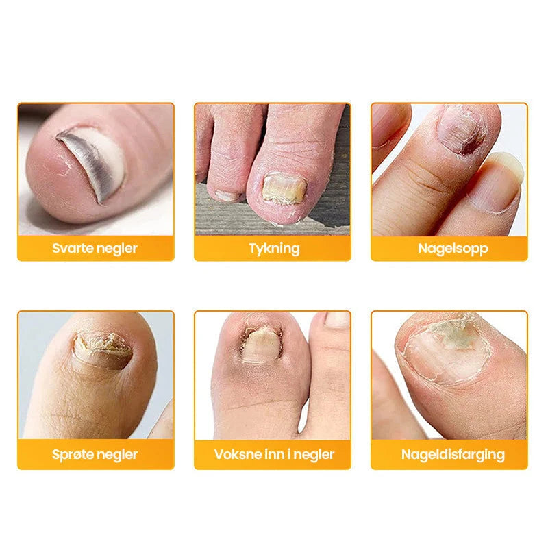 Nail Fungus Patch | Deep-Acting Antifungal & Medical Fleece | Pack of 2