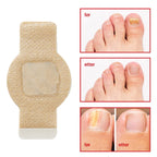 Nail Fungus Patch | Deep-Acting Antifungal & Medical Fleece | Pack of 2