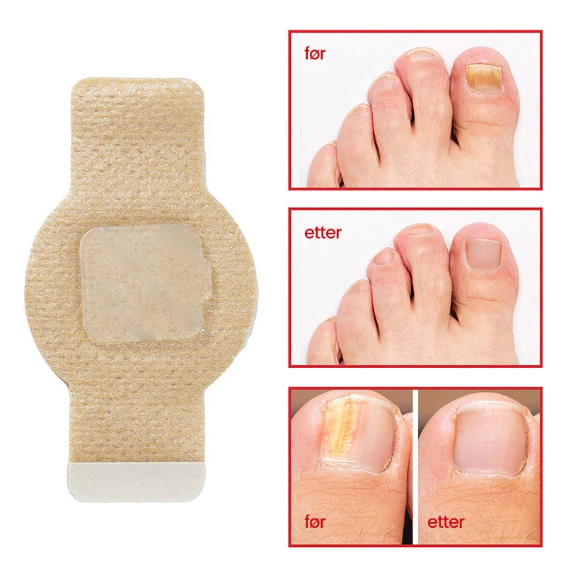 Nail Fungus Patch | Deep-Acting Antifungal & Medical Fleece | Pack of 2